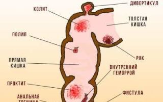 Лечение кровоточащего геморроя в домашних условиях