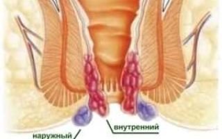 Как снять воспаление геморроя в домашних условиях