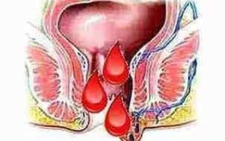 Препараты для лечения кровоточащего геморроя