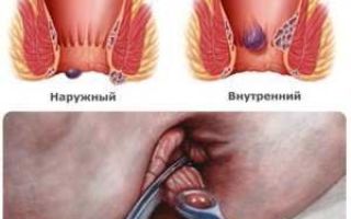 Какие могут быть осложнения после операции по удалению геморроя