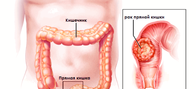 Геморрой и рак прямой кишки