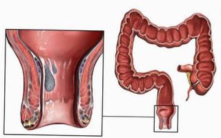 Стадии геморроя