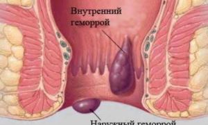 Разберемся, как проявляется геморрой